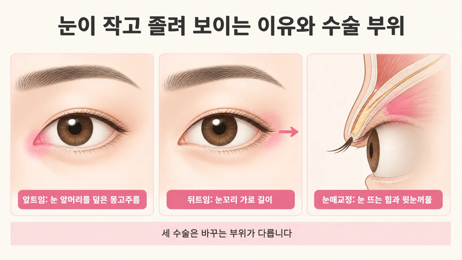 앞트임은 눈 앞머리, 뒤트임은 눈꼬리, 눈매교정은 윗눈꺼풀을 조정하는 부위를 표시한 그림