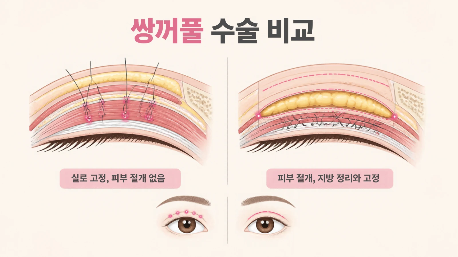 쌍꺼풀 매몰법은 실로 눈꺼풀 안쪽 조직을 고정해 피부를 절개하지 않고, 절개법은 눈꺼풀 피부를 절개해 지방을 정리하고 고정하는 모습을 윗눈꺼풀 단면으로 나란히 그린 비교 그림