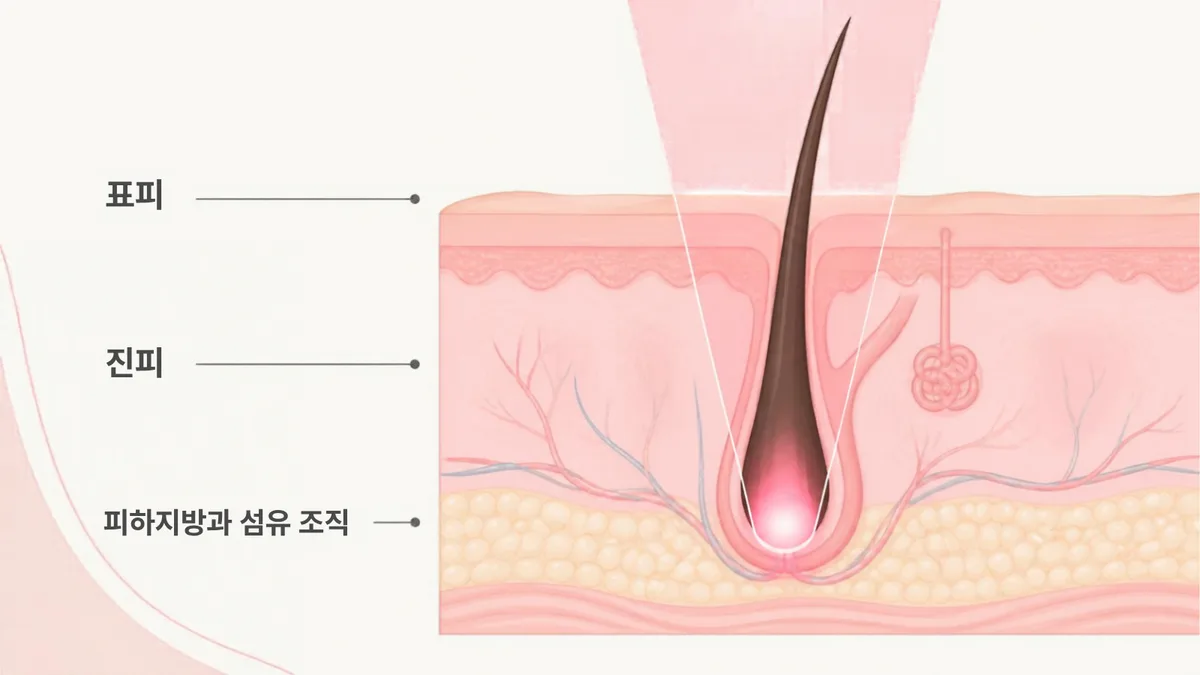 표피와 진피를 지나 피하지방과 섬유 조직까지 내려간 하나의 모낭을 확대해, 레이저 빛이 위에서 내려와 털과 모낭의 어두운 부분에 모이는 모습을 표피, 진피, 피하지방과 섬유 조직 순서로 그린 그림