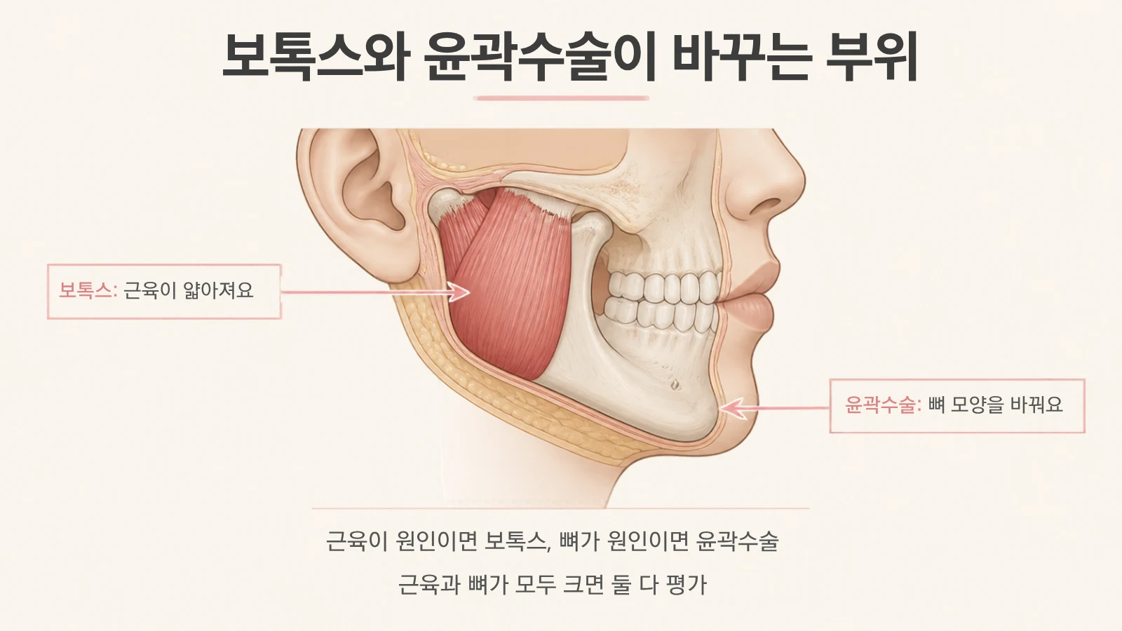 사각턱 보톡스가 작용하는 씹는 근육과 윤곽수술로 다듬는 아래턱뼈를 구분한 설명 그림