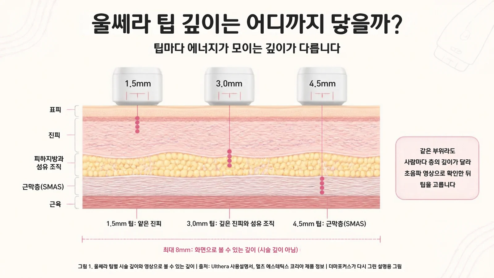 피부 단면에 1.5mm, 3.0mm, 4.5mm 시술 깊이와 최대 8mm 영상 깊이를 나눠 표시한 울쎄라 초음파 깊이 설명 그림